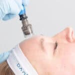Aesthetic treatment with a syringe during a facial procedure at a luxury medspa in Brookhaven, GA.