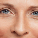 Why We Use Both Hyaluronic Acid & Calcium-Based Fillers