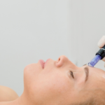 microneedling treatments in Atlanta?