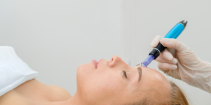 microneedling treatments in Atlanta?