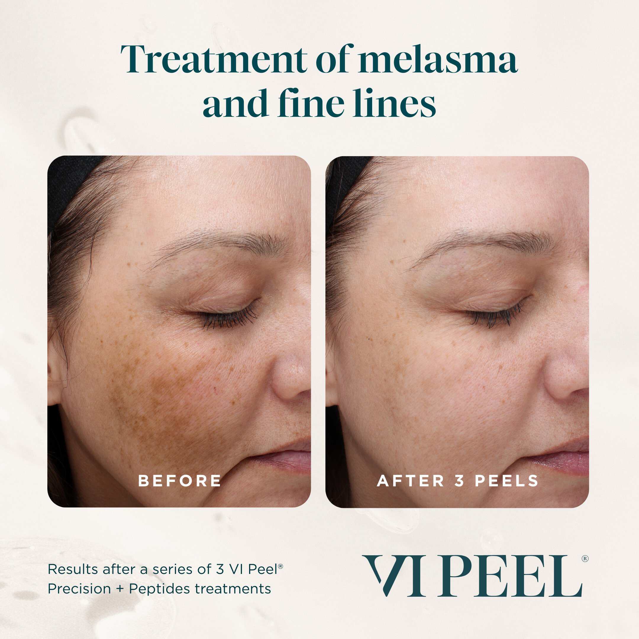 Before and after images showing results of 3 VI Peel treatments.