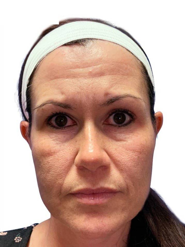 Woman with smooth, glowing skin, and a headband, showcasing facial treatment results.
