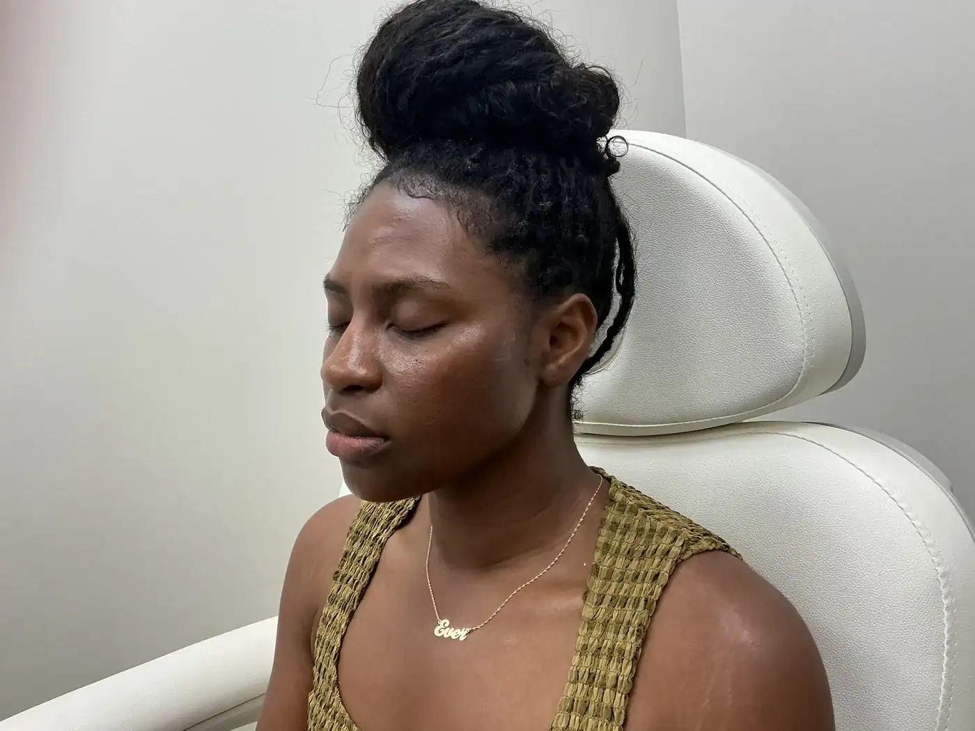 Same patient after cheek and chin filler